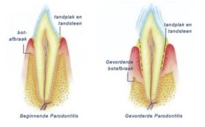 mondhygieniste-tilburg-reeshof-parodontitis